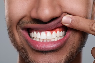 Image of Man showing inflamed gum on grey background, closeup