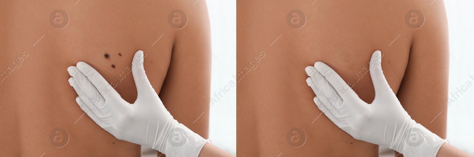 Image of Collage with photos of patient's back before and after mole removing procedure, closeup. Dermatologist checking man's skin