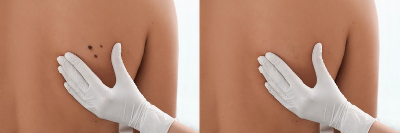 Image of Collage with photos of patient's back before and after mole removing procedure, closeup. Dermatologist checking man's skin