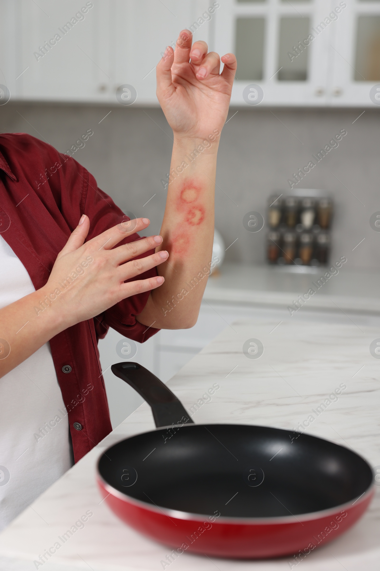 Photo of Woman with burns on her hand in kitchen, closeup