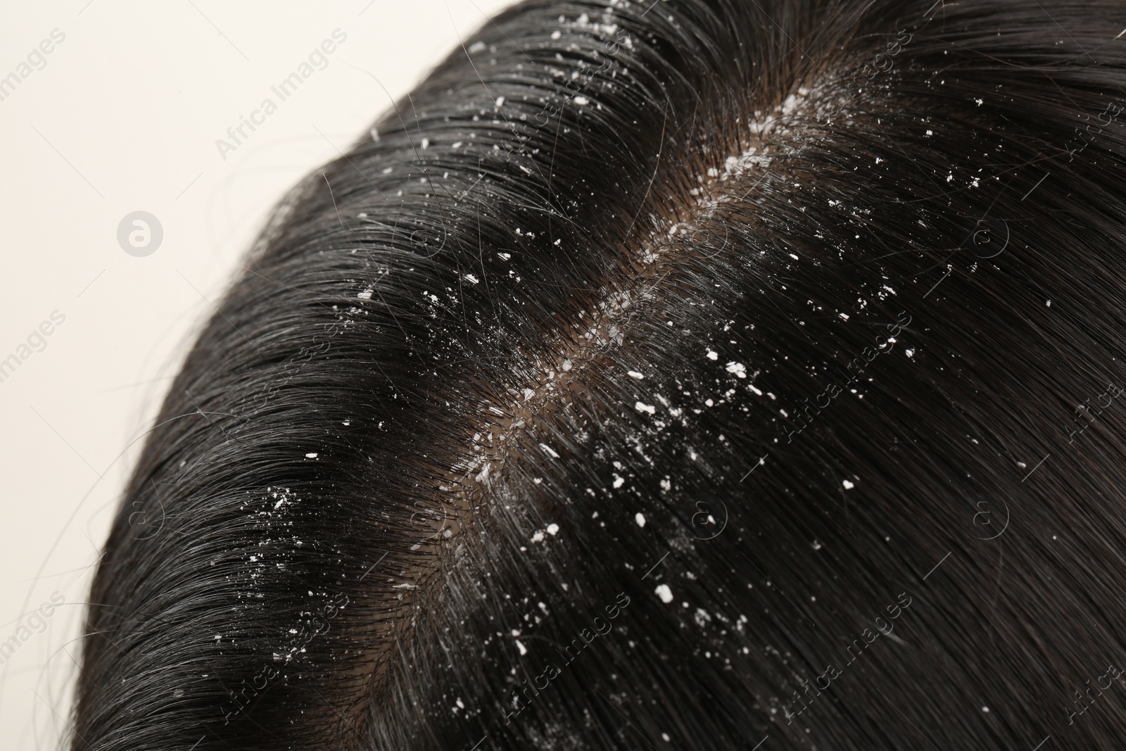 Photo of Woman with dandruff in her dark hair on white background, closeup