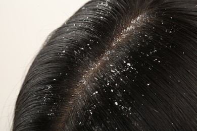 Photo of Woman with dandruff in her dark hair on white background, closeup