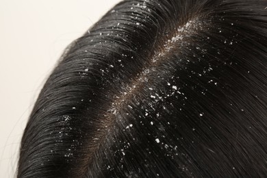 Woman with dandruff in her dark hair on white background, closeup