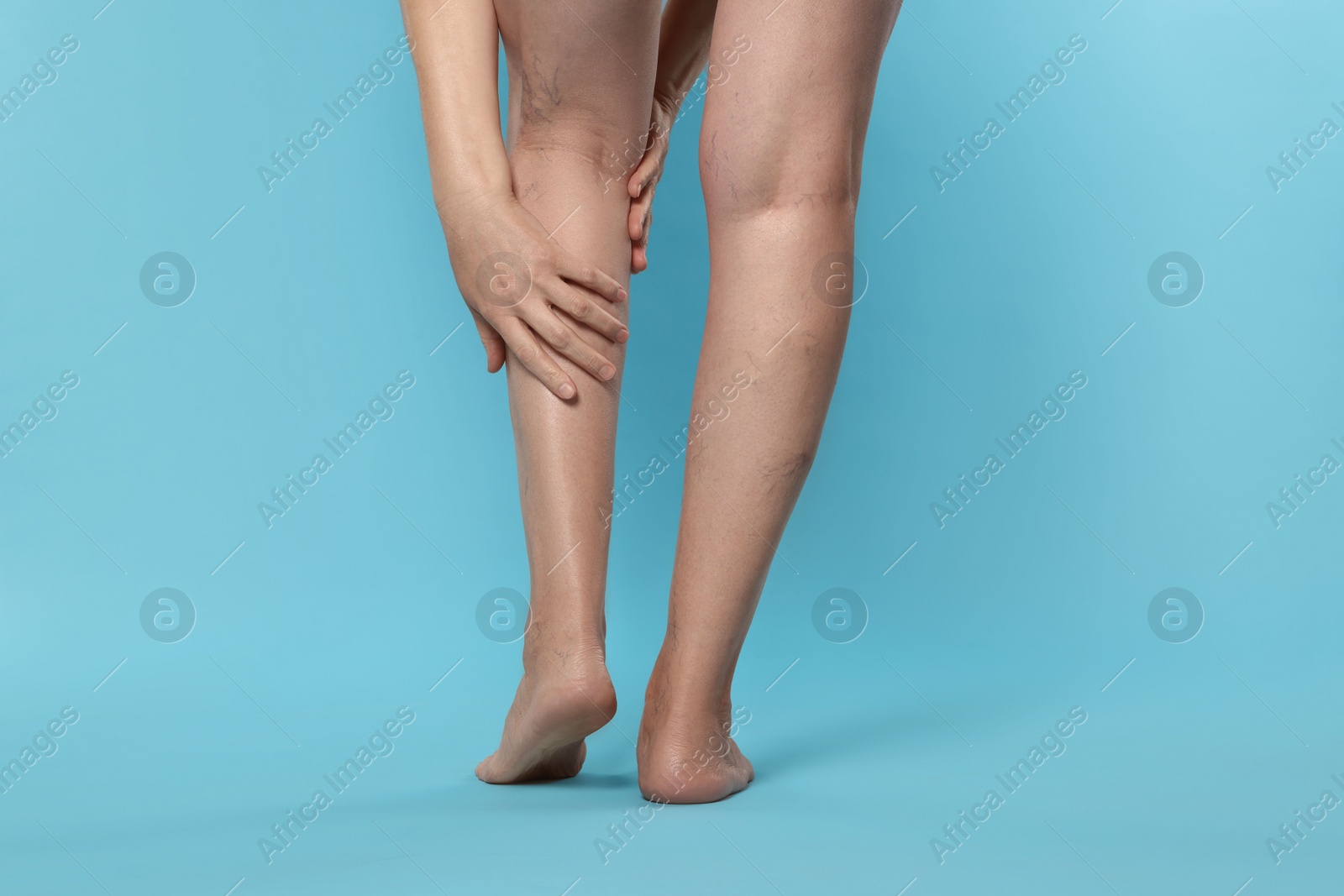 Photo of Closeup view of woman suffering from varicose veins on light blue background