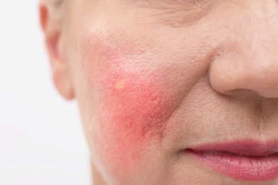 Image of Woman with rosacea on white background, closeup. Problem skin treatment
