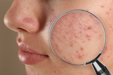 Dermatology. Man with skin problem, closeup. View through magnifying glass on acne