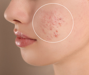 Image of Teenage girl with acne problem on beige background, closeup
