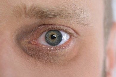 Image of Tired man with dark circle under eye, closeup
