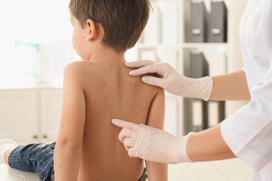 Photo of Doctor examining little boy with chickenpox in clinic, closeup. Varicella zoster virus