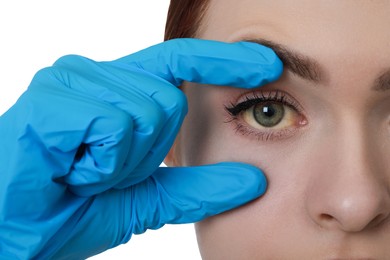 Photo of Doctor checking woman with yellow eyes on white background, closeup. Symptom of hepatitis