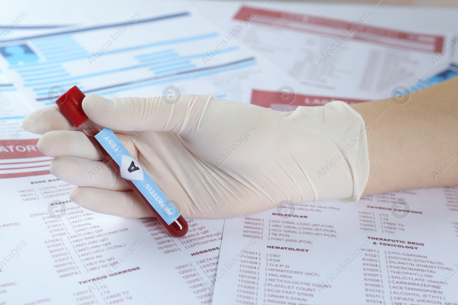 Photo of Scientist holding tube with blood sample and label Hepatitis A Test against laboratory forms, closeup
