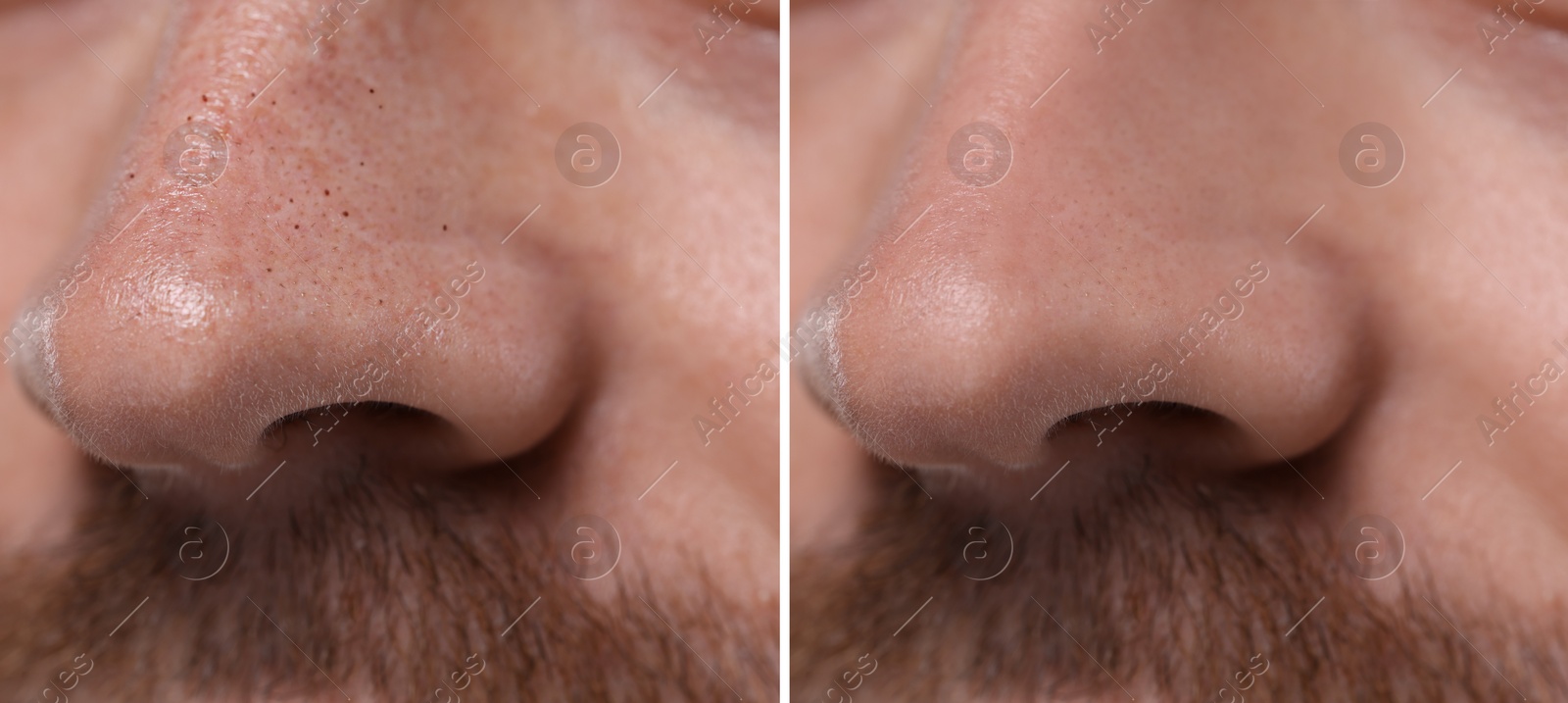 Image of Blackhead treatment, before and after. Collage with photos of man, closeup view