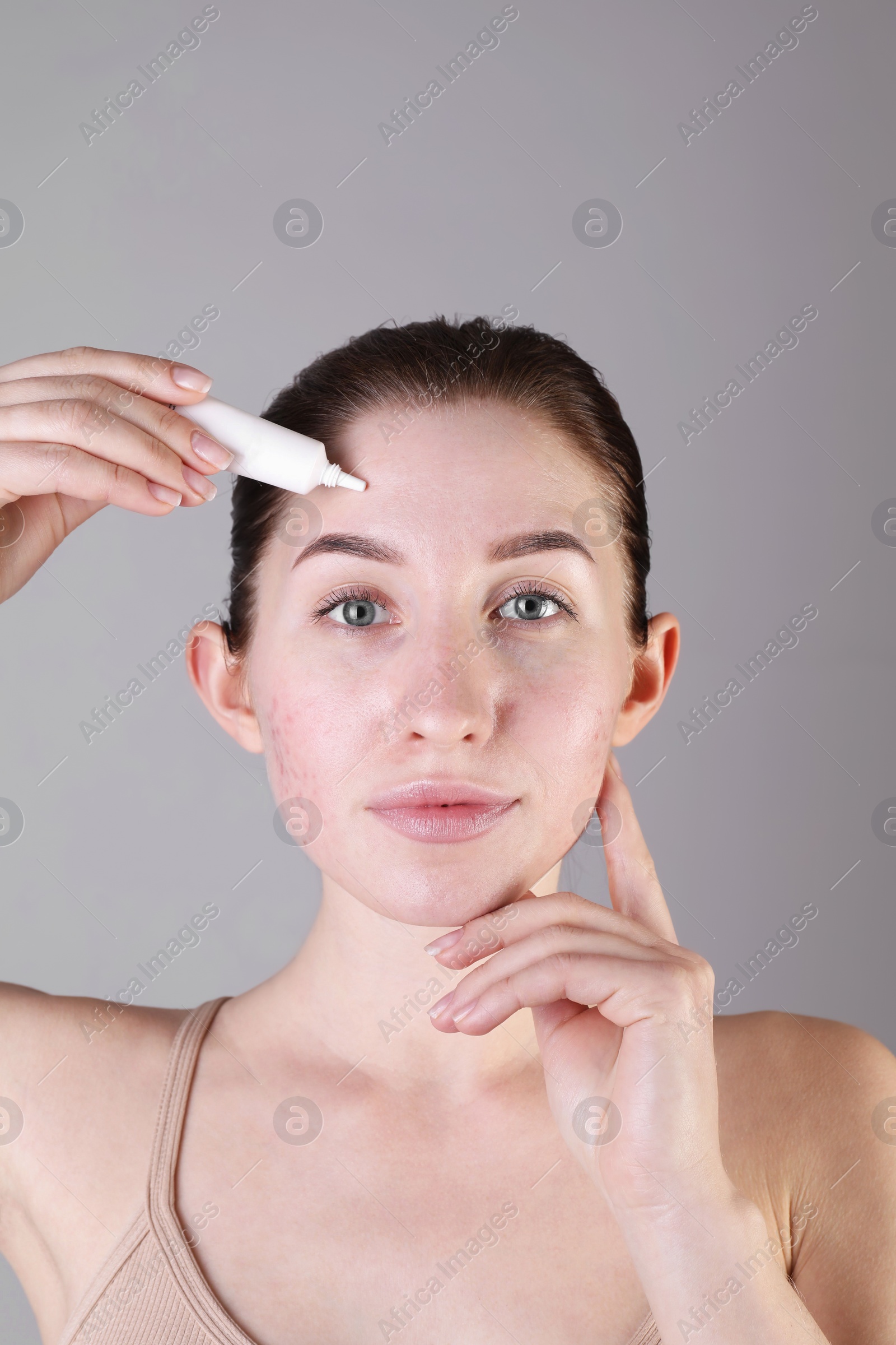 Photo of Young woman with acne problem applying cosmetic product onto her skin on light grey background