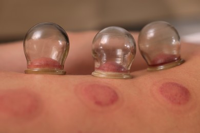 Cupping therapy. Closeup view of man with glass cups on his back indoors