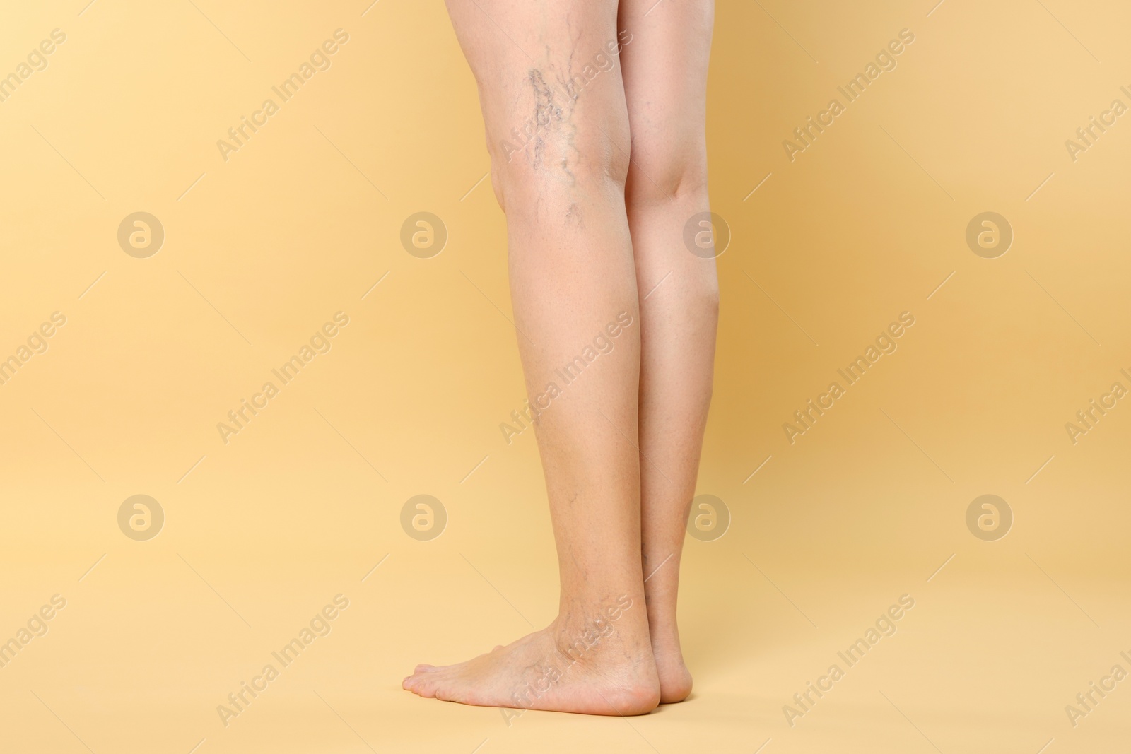 Photo of Closeup view of woman with varicose veins on yellow background