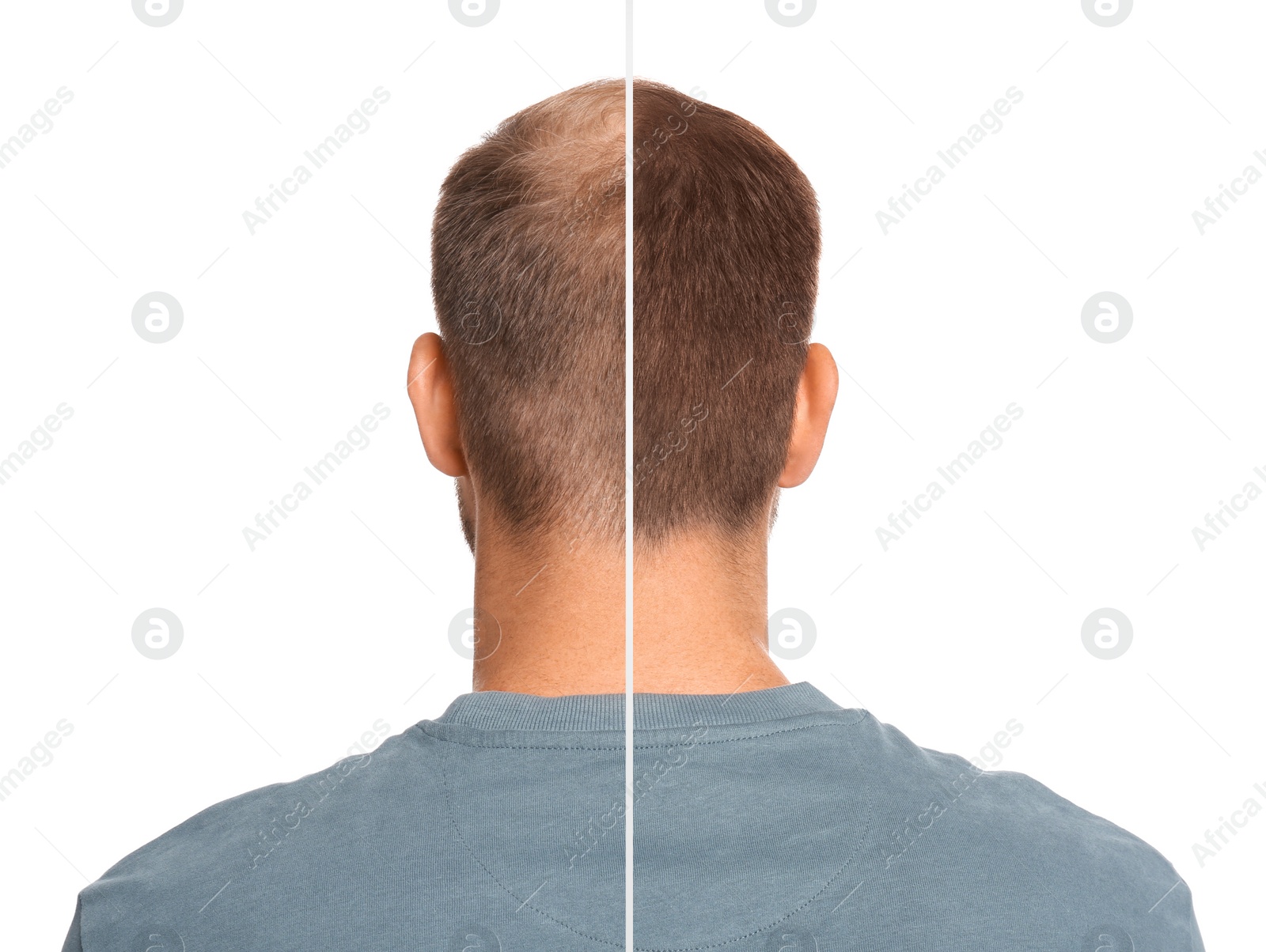 Image of Man with hair loss problem before and after treatment on white background, collage. Visiting trichologist