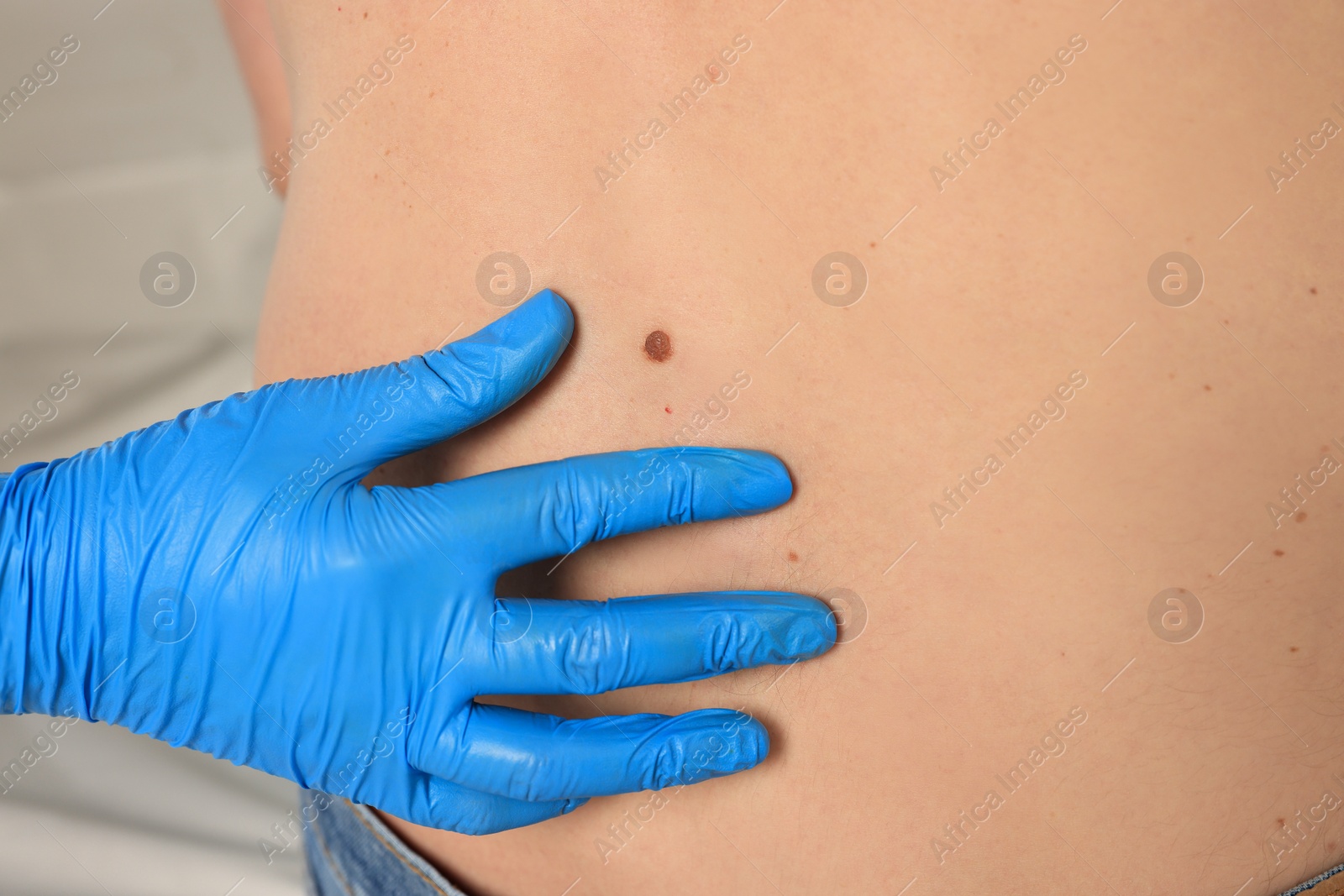 Photo of Dermatologist examining patient's birthmark indoors, closeup view