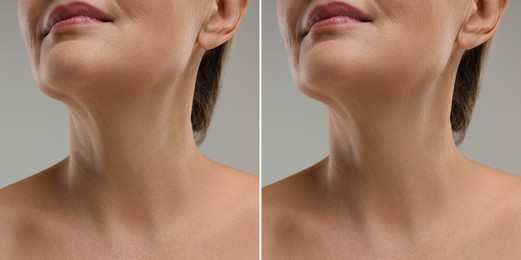 Image of Collage with photos of woman before and after cosmetic procedure on grey background, closeup