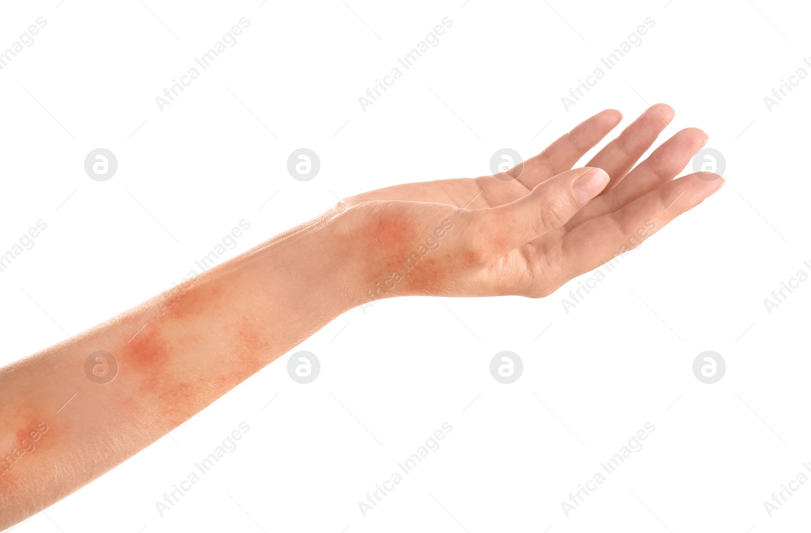 Image of Woman showing hand with dry skin on white background, closeup