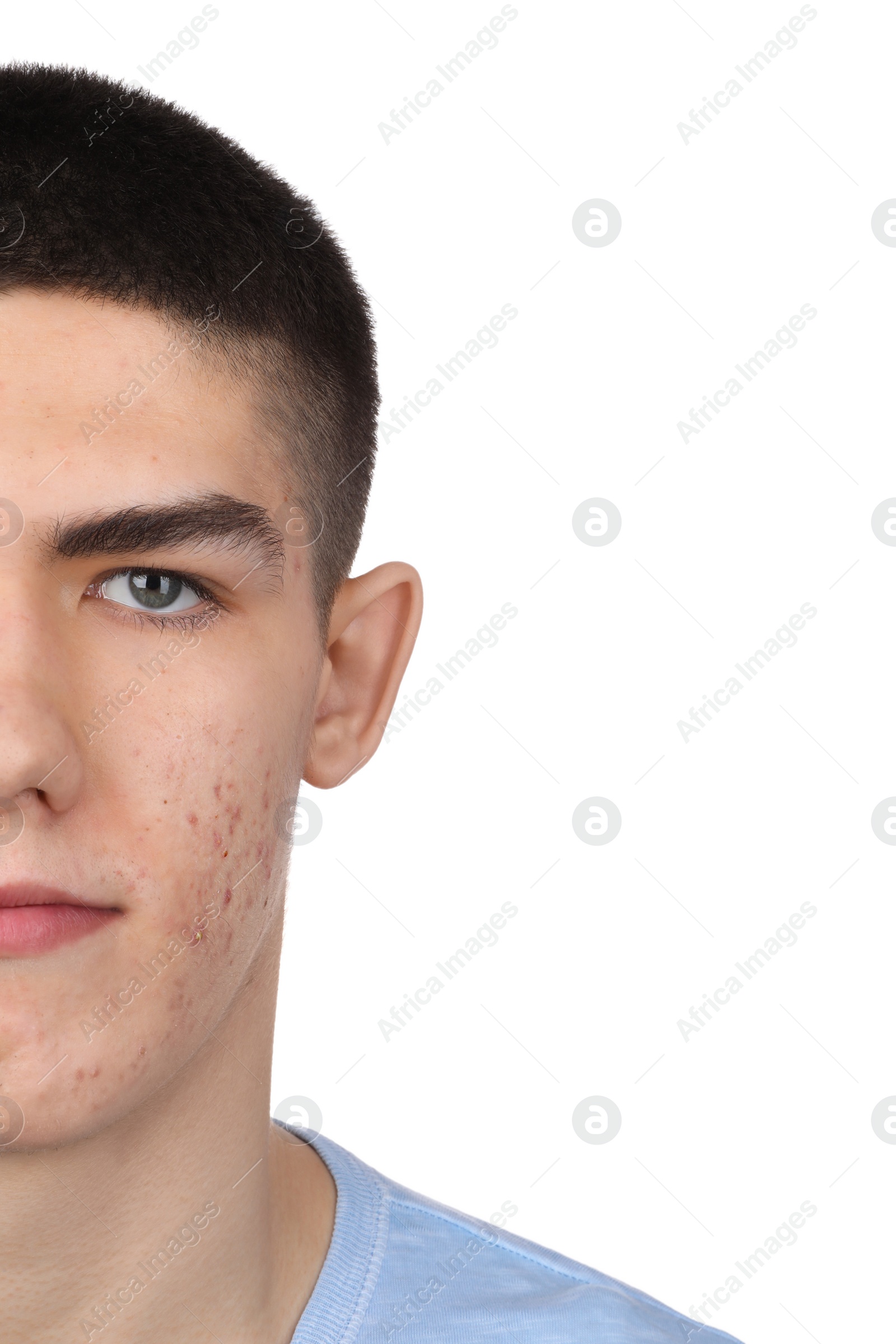 Photo of Young man with acne problem isolated on white