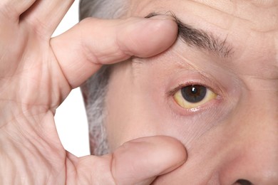 Photo of Senior man with yellow eyes on light background, closeup. Symptom of hepatitis