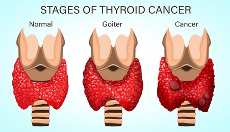Illustration of Set with illustration of healthy and diseased thyroid on light background. Stages of development cancer