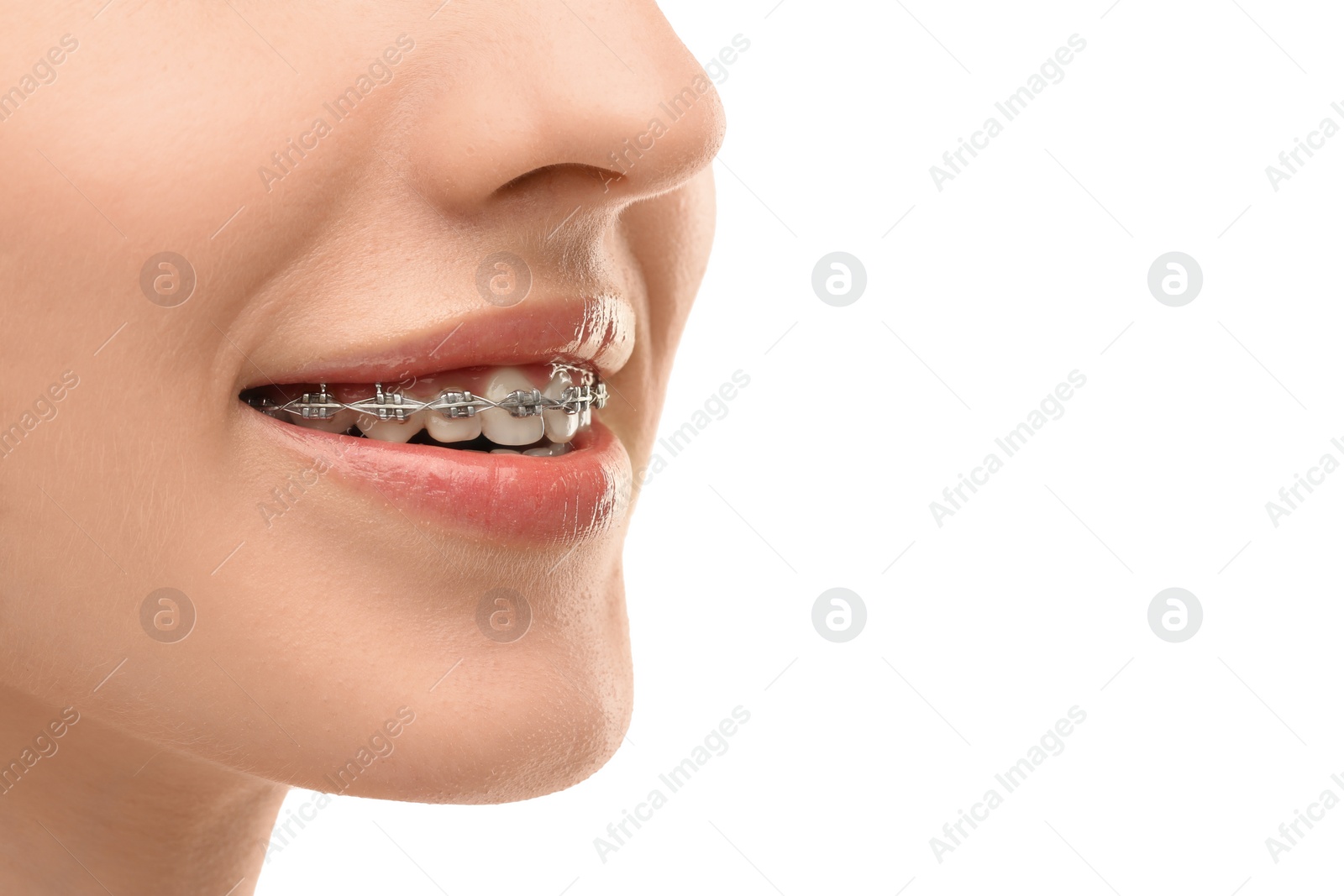 Photo of Smiling woman with dental braces on white background, closeup