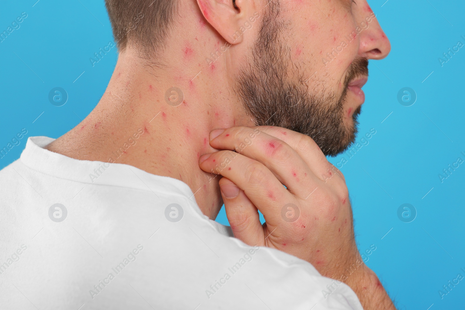 Photo of Man with rash suffering from monkeypox virus on light blue background, closeup