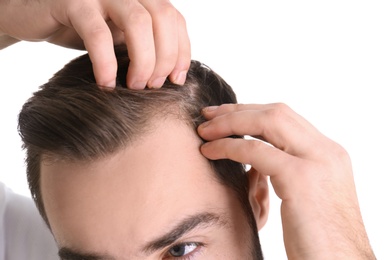 Young man with hair loss problem on white background, closeup