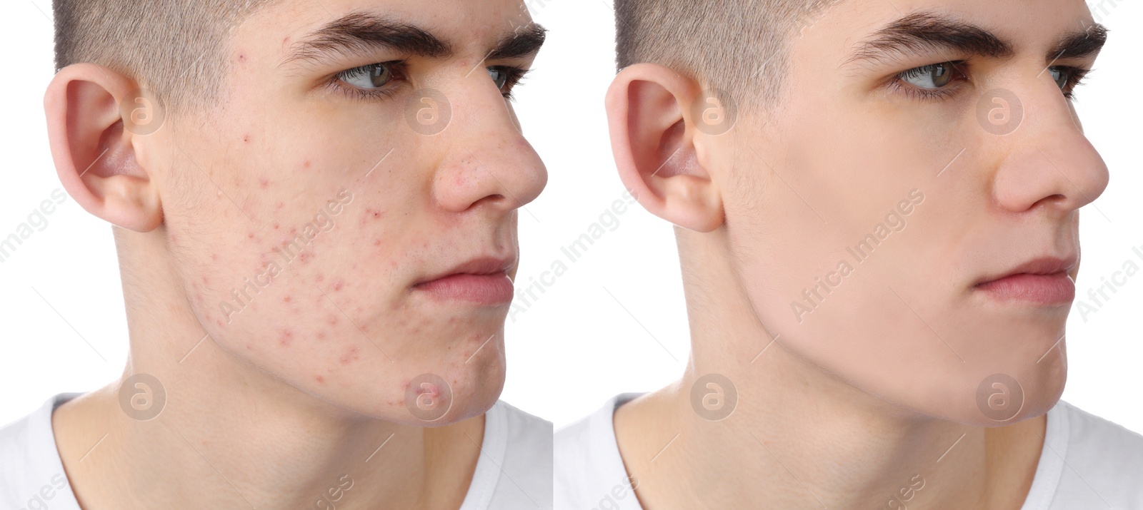 Image of Acne problem. Young man before and after treatment on white background, collage of photos