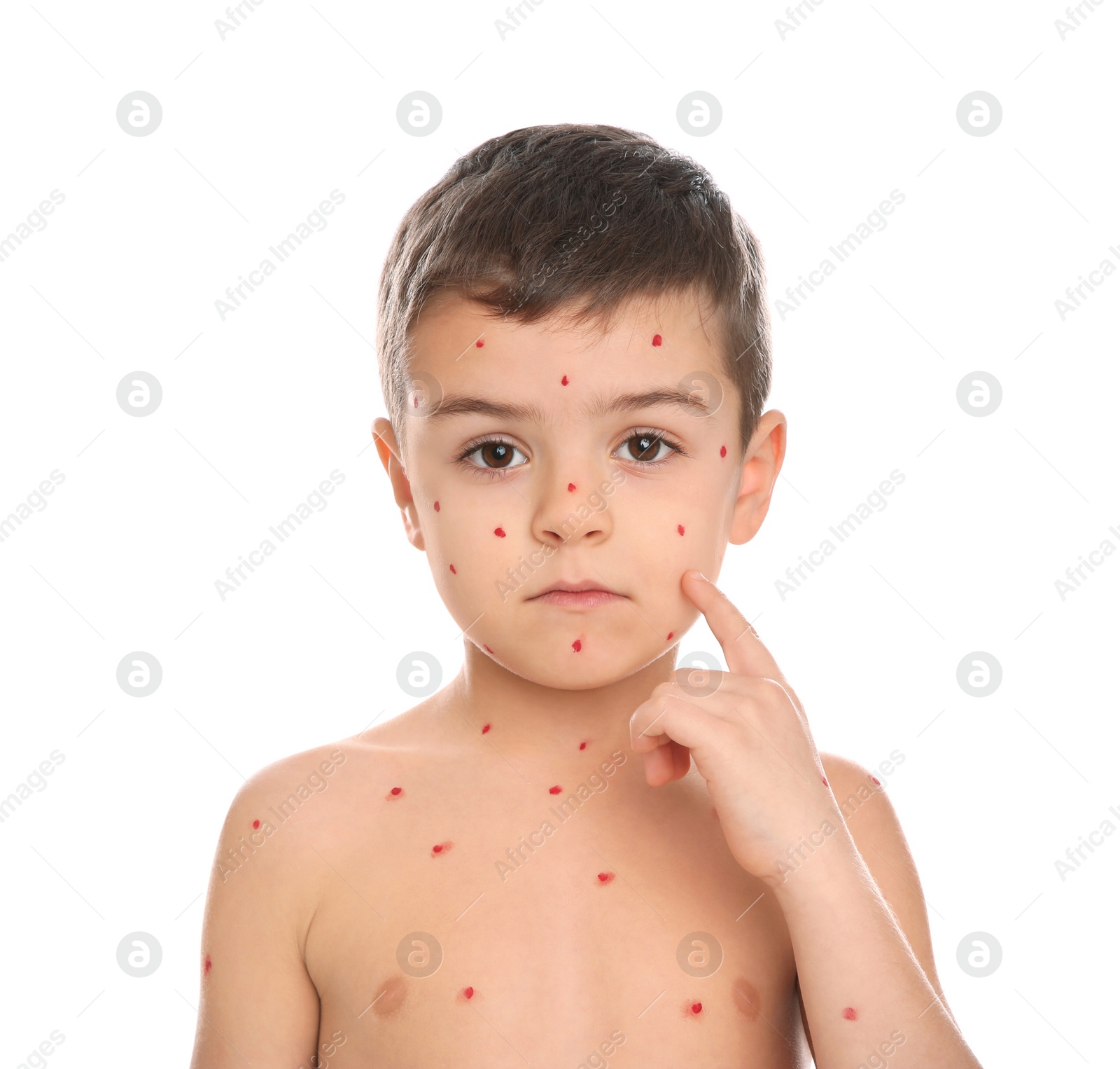 Photo of Little boy with chickenpox on white background