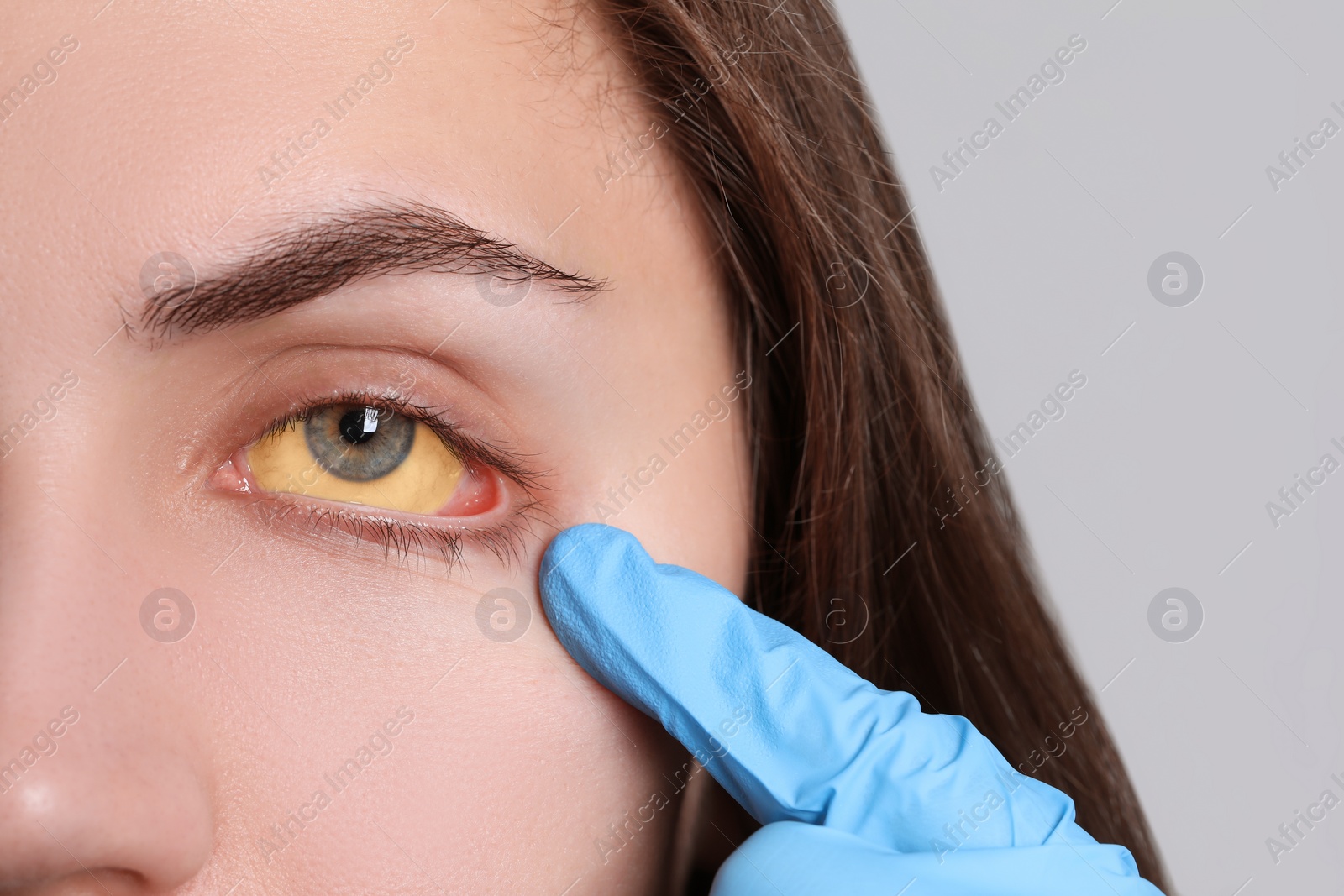Photo of Doctor checking woman with yellow eyes on light background, closeup. Symptom of hepatitis