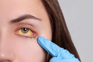 Doctor checking woman with yellow eyes on light background, closeup. Symptom of hepatitis