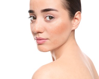 Image of Young woman with dry skin on white background