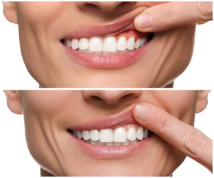 Image of Woman showing gum before and after treatment on white background, collage of photos