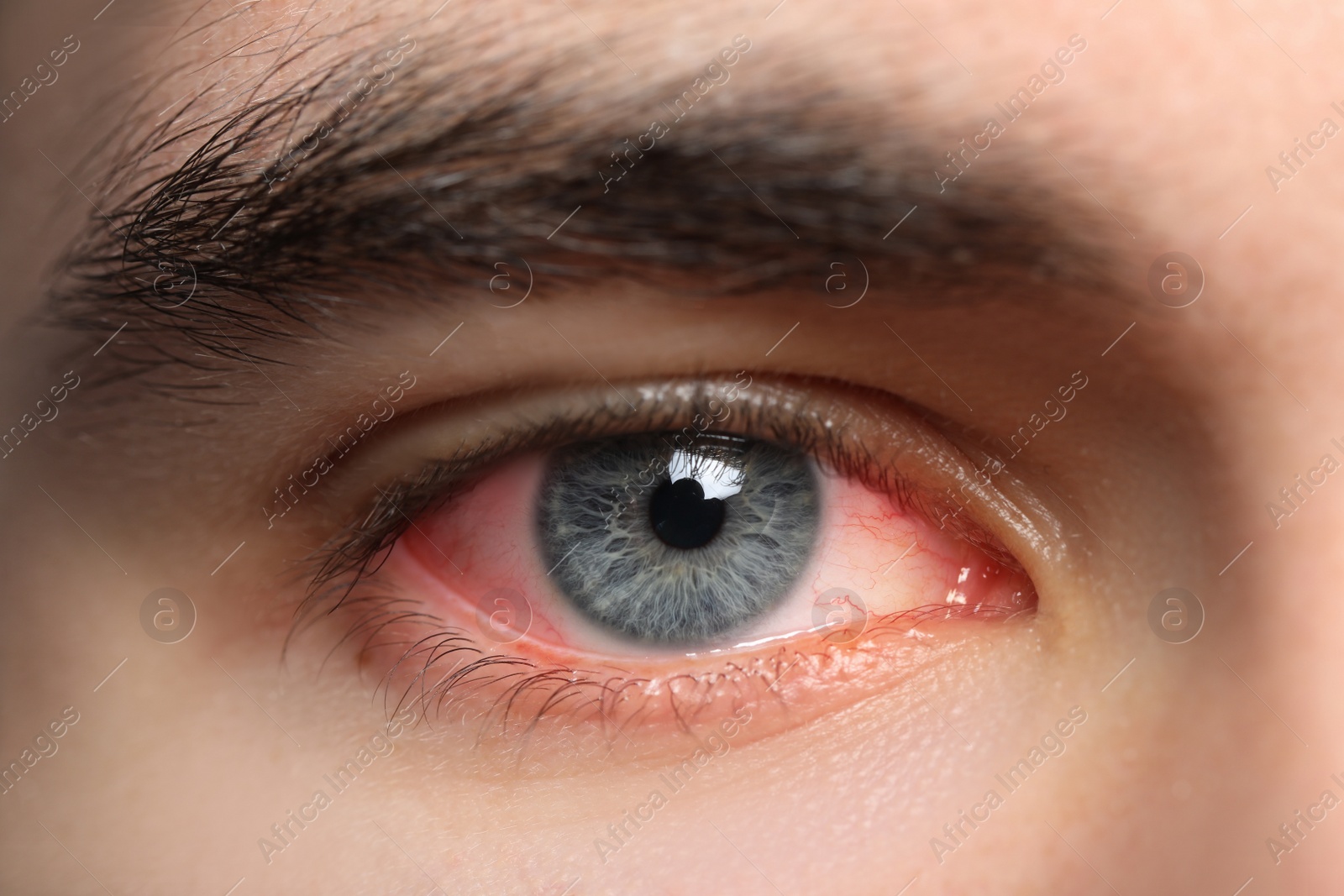 Image of Closeup view of man with inflamed eyes