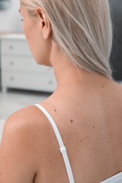 Closeup view of woman`s body with birthmarks indoors