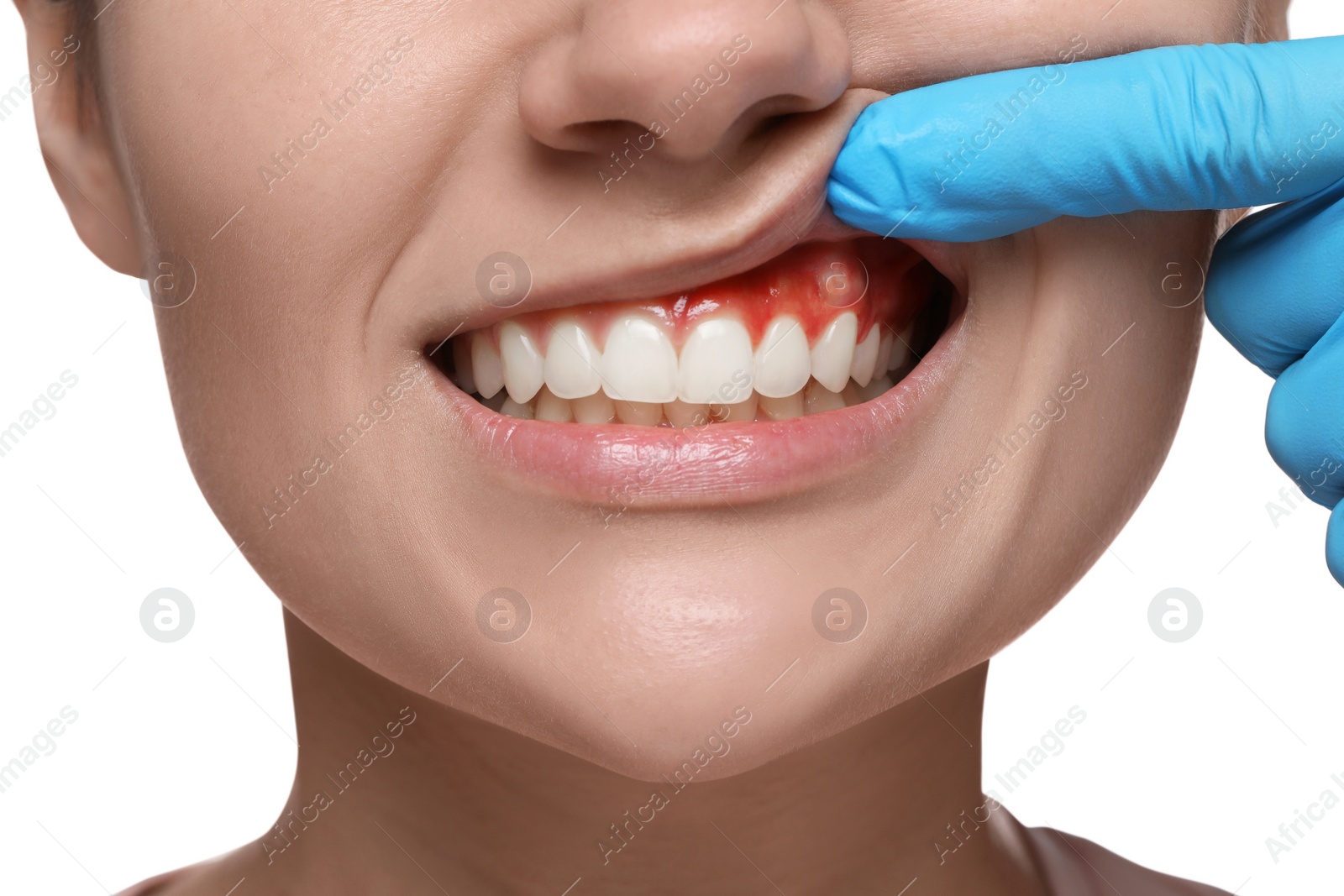 Image of Doctor examining woman's inflamed gum on white background, closeup