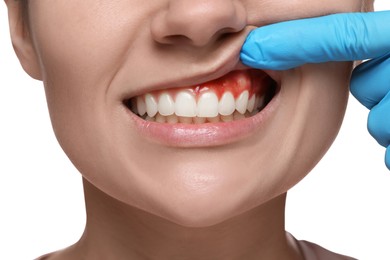 Doctor examining woman's inflamed gum on white background, closeup