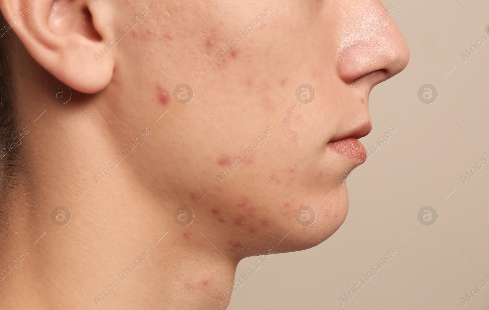 Photo of Teen guy with acne problem on beige background, closeup