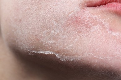 Photo of Woman with dry skin on face, closeup