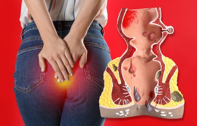 Image of Anatomical model of rectum with hemorrhoids and woman suffering from pain on red background, closeup