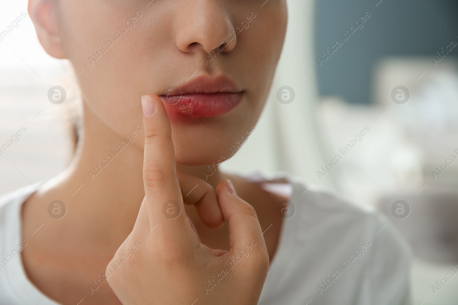 Photo of Woman with herpes touching lips against blurred background, closeup