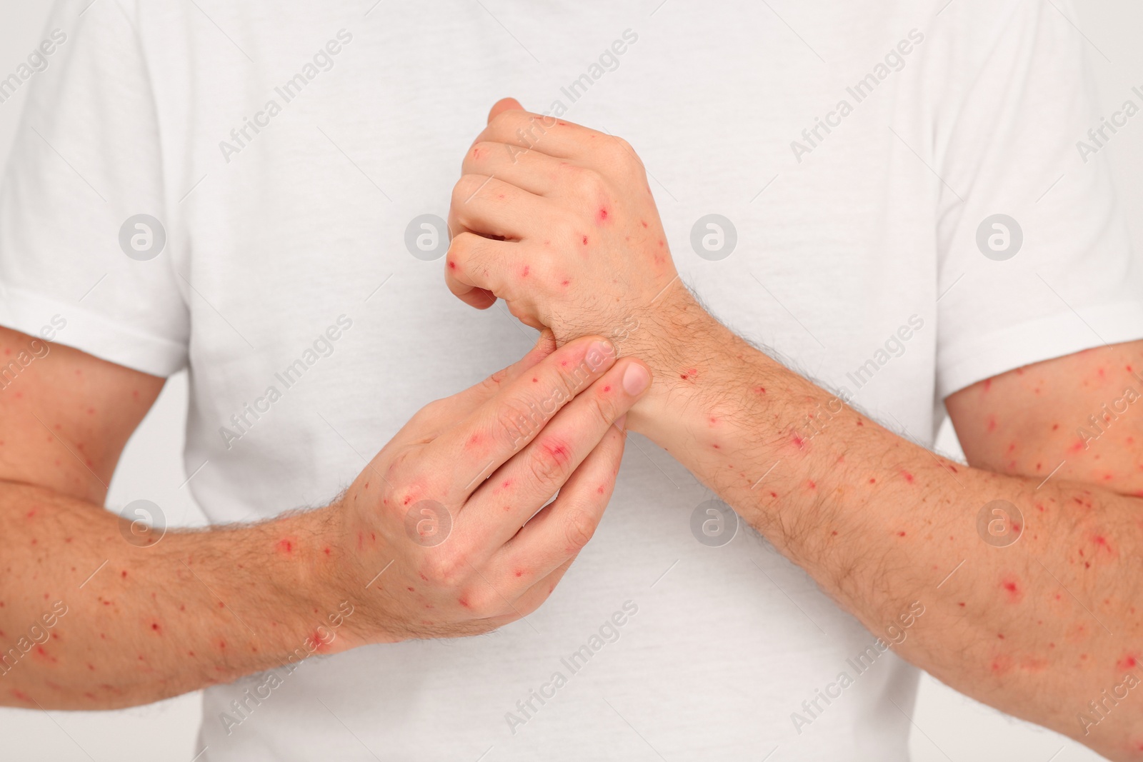 Photo of Man with rash suffering from monkeypox virus on beige background, closeup