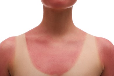 Photo of Woman with sunburned skin on white background, closeup