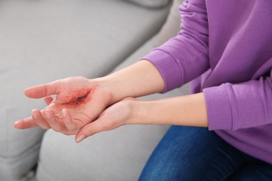 Photo of Young woman with injured hand at home, closeup. First aid