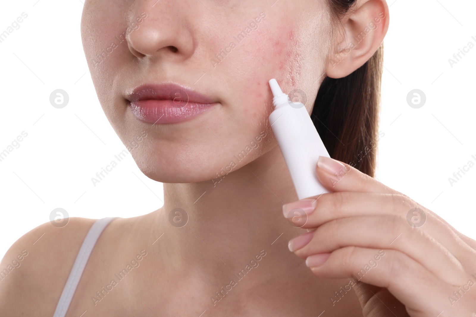 Photo of Young woman with acne problem applying cosmetic product onto her skin on white background, closeup