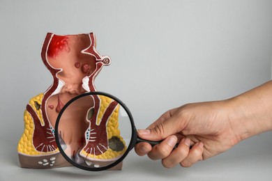 Proctologist holding magnifying glass near anatomical model of rectum with hemorrhoids on light background, closeup