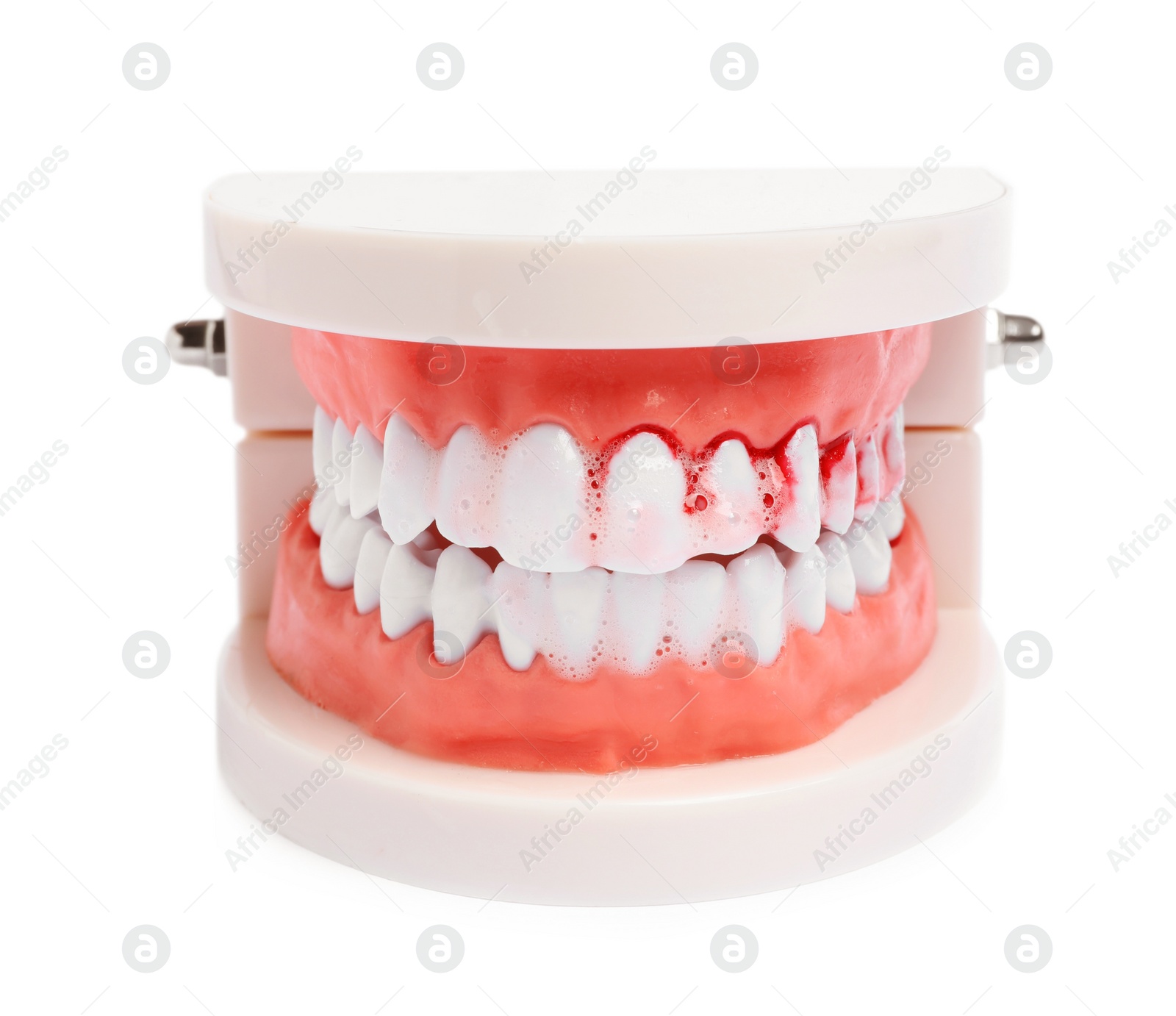 Photo of Model of jaw and toothpaste foam with blood on white background. Gum problems