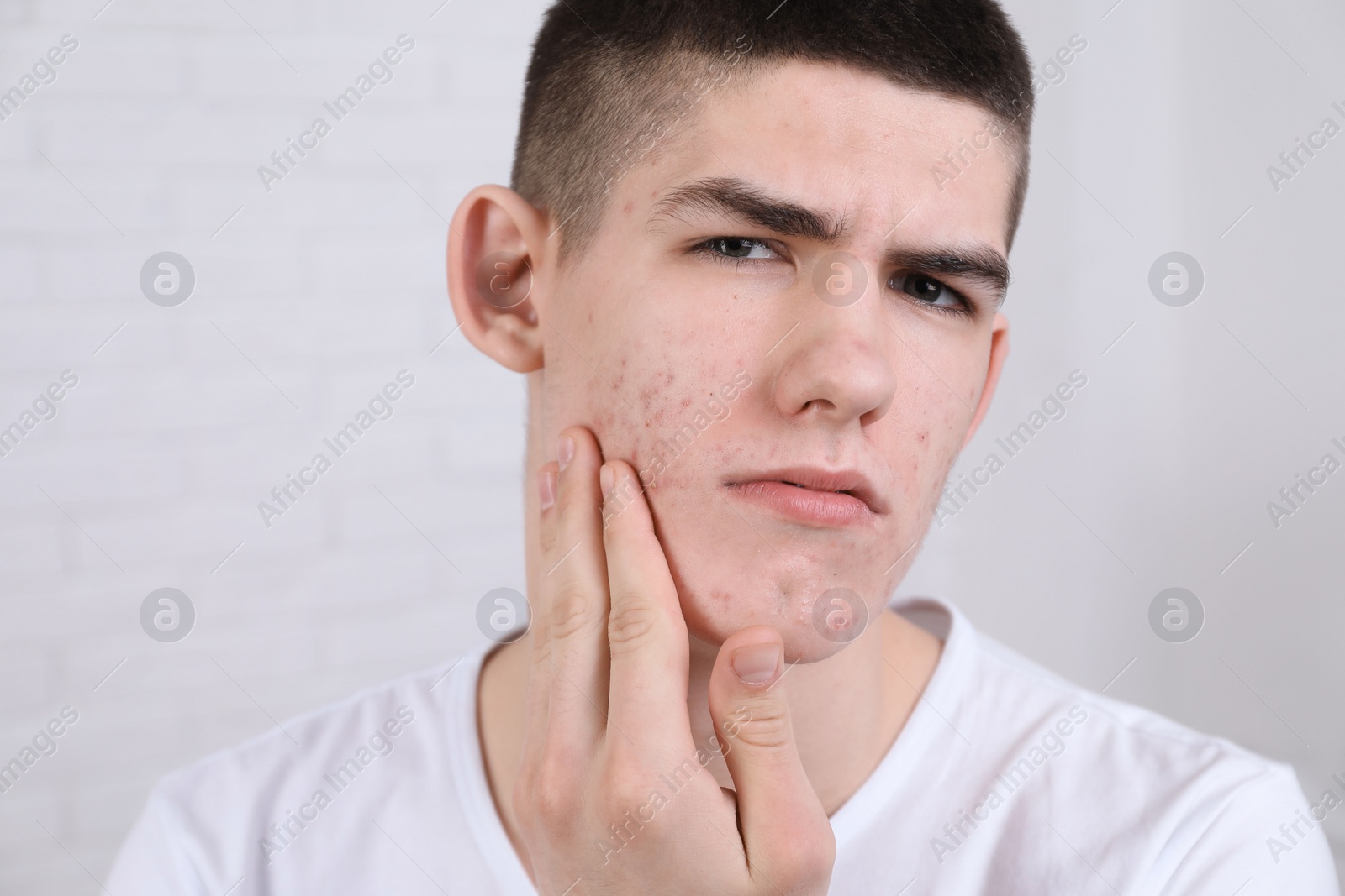 Photo of Young man touching pimple on his face indoors. Acne problem